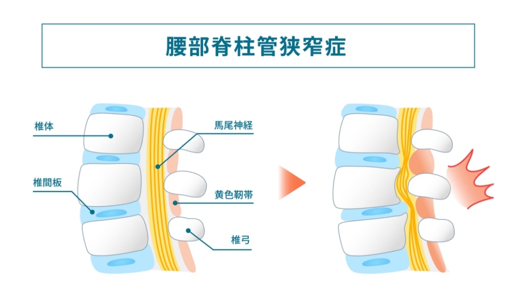 脊柱管狭窄症のしくみ-min